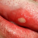 Abscess on the tongue