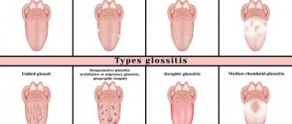 aphthous stomatitis - types