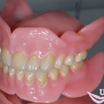 acrylic dentures