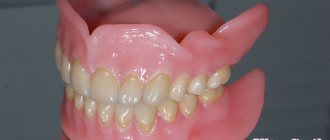 acrylic dentures