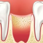 Альвеолит после удаления зуба - симптомы и лечение