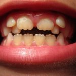Anomalies in tooth shape, treatment and prevention