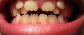 Аномалии формы зубов, лечение и профилактика
