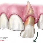 Аутотрансплантация зубов
