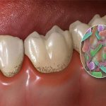Bacteria on gums