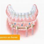 Beam fastening of removable dentures on implants in pictures