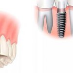 Basal dental implantation