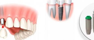 Basal dental implantation