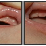 white spots and spots on the gums of infants