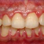 White plaque on gums