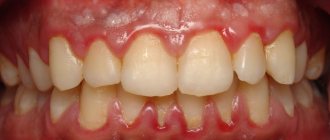 White plaque on gums