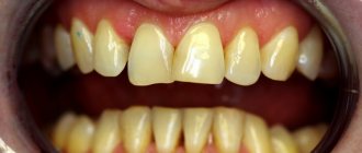 Metal-free crowns on teeth - photo before treatment
