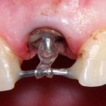 Болит зуб со штифтом без нерва