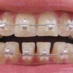 In-Ovation braces