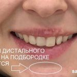 Braces correct distal bite, but you need to seek help from a professional