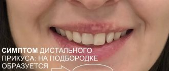 Braces correct distal bite, but you need to seek help from a professional