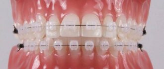ceramic braces clarity photo