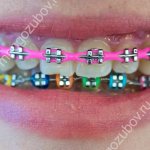braces with colored rubber bands