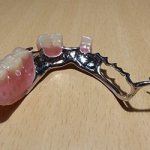 Clasp prosthesis with locks