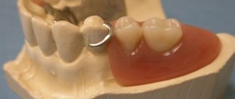 Clasp denture with clasps