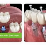 cement and screw fixation of dental bridge