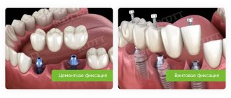 cement and screw fixation of dental bridge
