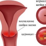 Cervicitis. Treatment in Moscow. 