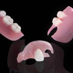 Partial removable dentures - an alternative to implantation
