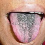 Black coating on the tongue