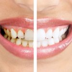 Teeth cleaning with Air Flow or ultrasound: which is better?