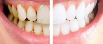 чистка зубов до и после