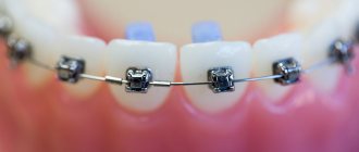 Чистка зубов после установки брекет-систем усложняется.