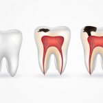 What to do if the enamel on your teeth is worn away?