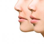 What to do after lip augmentation - Photo 1
