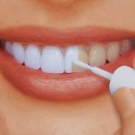 What is dental varnish?
