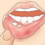 What is aphthous stomatitis