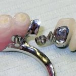 What is an attachment in dentistry