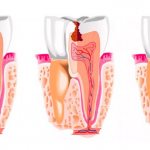 Что такое киста корня зуба?