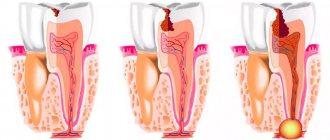 What is a tooth root cyst?