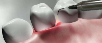 What is gum coagulation? Why do dentists do cauterization of mucous tissues? 