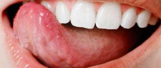what is macroglossia and how is it dangerous?