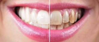 Что такое пигментация зубов