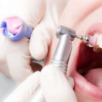What is teeth polishing