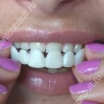 What are removable veneers
