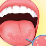 What is stomatitis and what types exist?