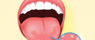 What is stomatitis and what types exist?