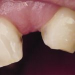 Dental defects