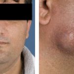 Деформация лица при челюстно-лицевом актиномикозе