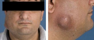 Деформация лица при челюстно-лицевом актиномикозе