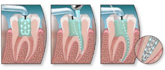 depophoresis in dentistry